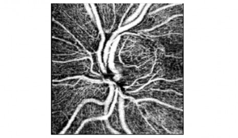 OCT Angiografía del nervio óptico